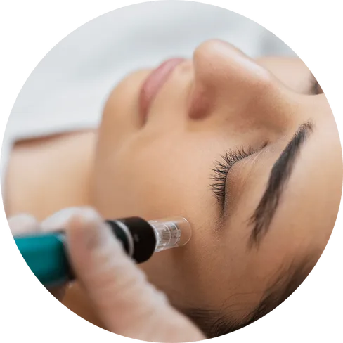 MB Kosmetik micro needling mit ionto